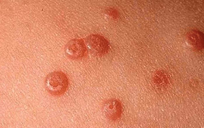 Treatment costs explained for genital warts laser Mashhad